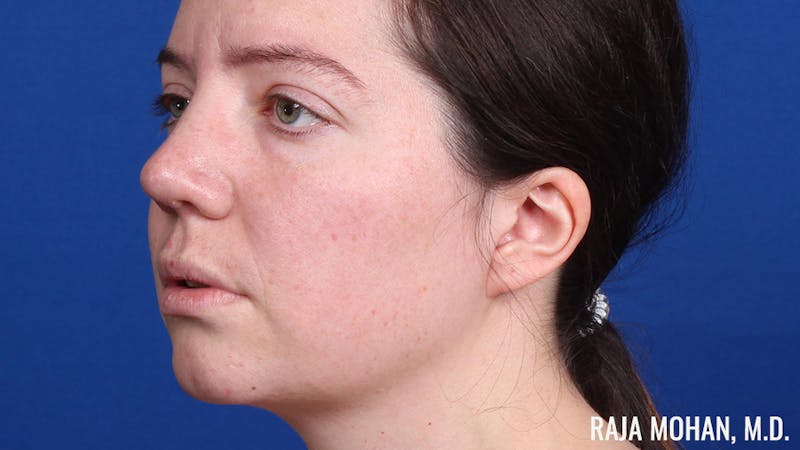 Rhinoplasty Before & After Gallery - Patient 250330 - Image 10