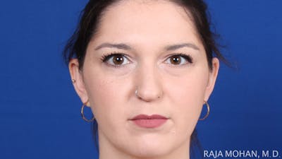 Rhinoplasty Before & After Gallery - Patient 263819 - Image 1
