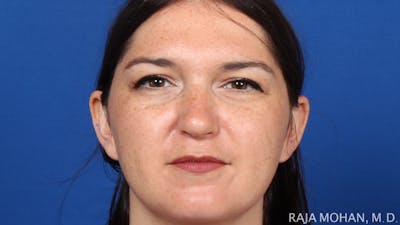 Rhinoplasty Before & After Gallery - Patient 263819 - Image 2