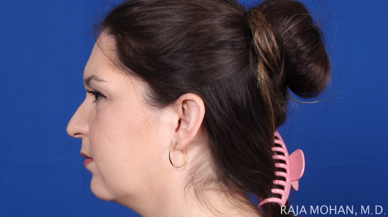 Rhinoplasty Before & After Gallery - Patient 263819 - Image 3