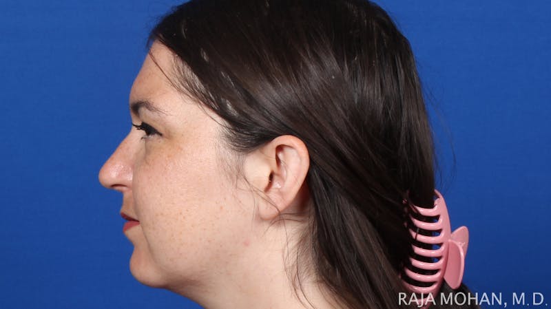 Rhinoplasty Before & After Gallery - Patient 263819 - Image 4