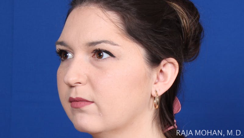 Rhinoplasty Before & After Gallery - Patient 263819 - Image 5
