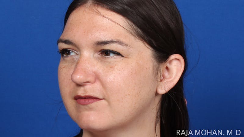 Rhinoplasty Before & After Gallery - Patient 263819 - Image 6