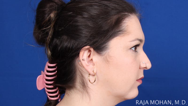 Rhinoplasty Before & After Gallery - Patient 263819 - Image 7
