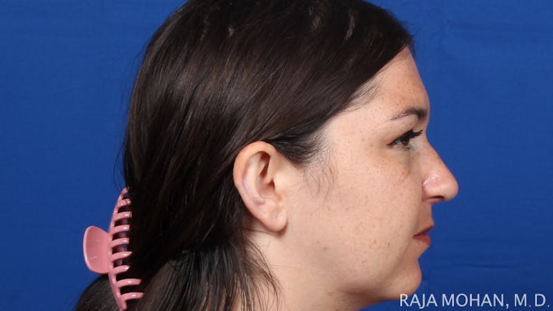 Rhinoplasty Before & After Gallery - Patient 263819 - Image 8