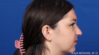 Rhinoplasty Before & After Gallery - Patient 263819 - Image 8