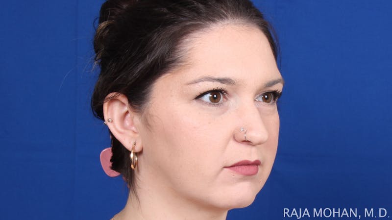 Rhinoplasty Before & After Gallery - Patient 263819 - Image 9