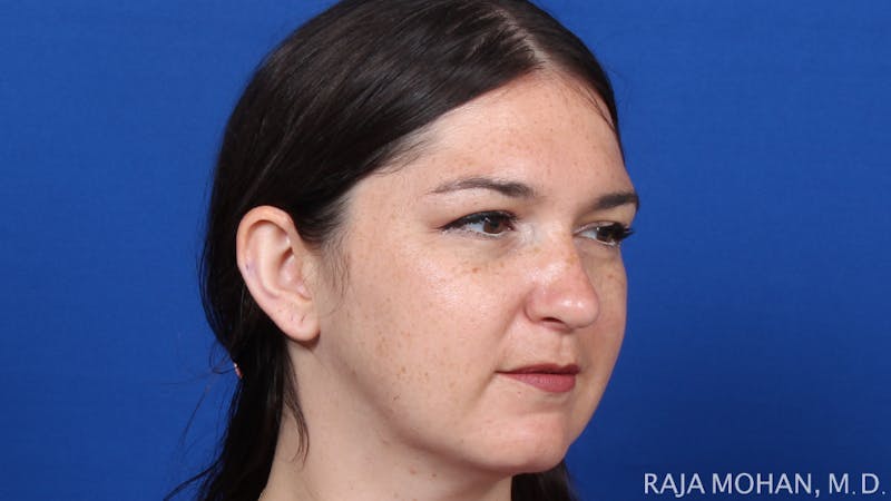 Rhinoplasty Before & After Gallery - Patient 263819 - Image 10