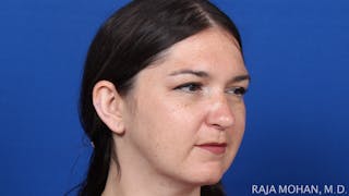 Rhinoplasty Before & After Gallery - Patient 263819 - Image 10