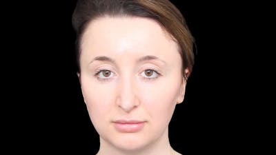 Rhinoplasty Before & After Gallery - Patient 289538 - Image 1