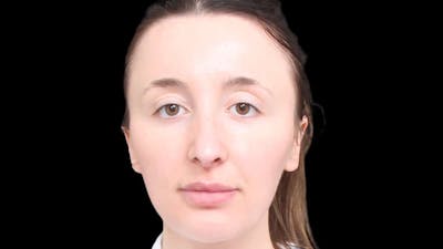 Rhinoplasty Before & After Gallery - Patient 289538 - Image 2