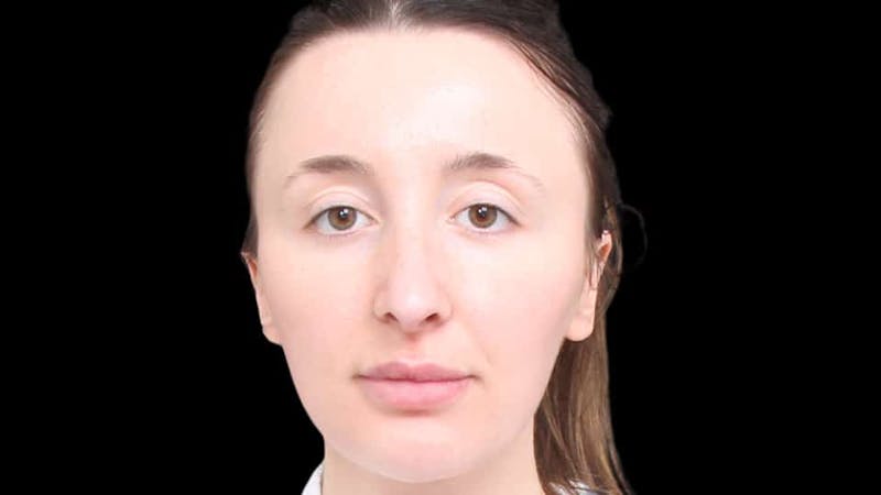 Rhinoplasty Before & After Gallery - Patient 289538 - Image 2