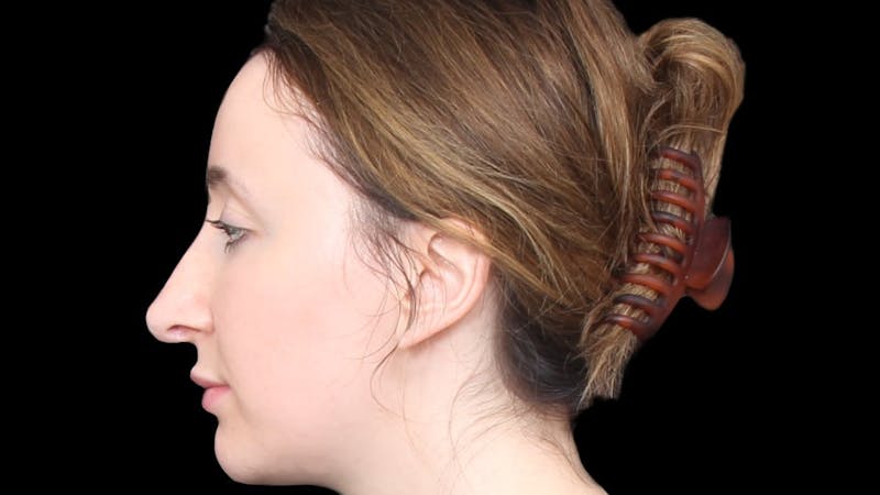 Rhinoplasty Before & After Gallery - Patient 289538 - Image 3