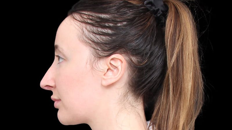 Rhinoplasty Before & After Gallery - Patient 289538 - Image 4