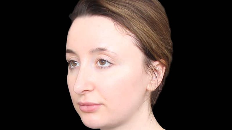 Rhinoplasty Before & After Gallery - Patient 289538 - Image 5