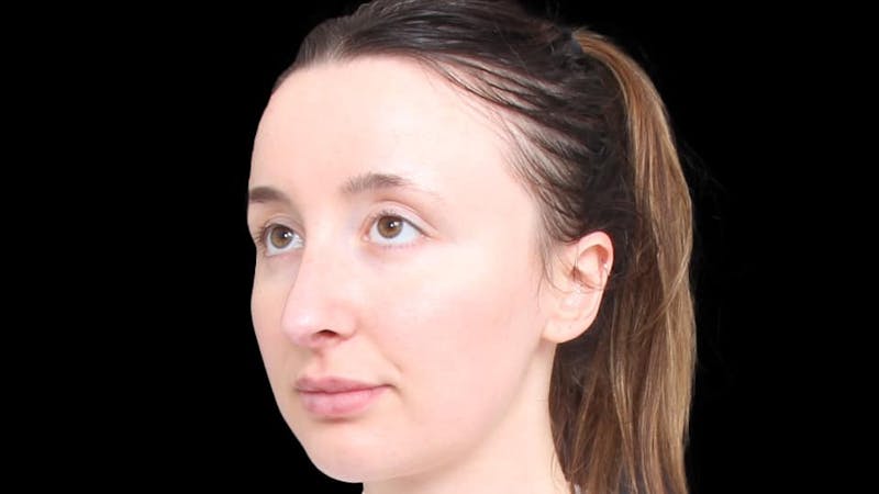 Rhinoplasty Before & After Gallery - Patient 289538 - Image 6