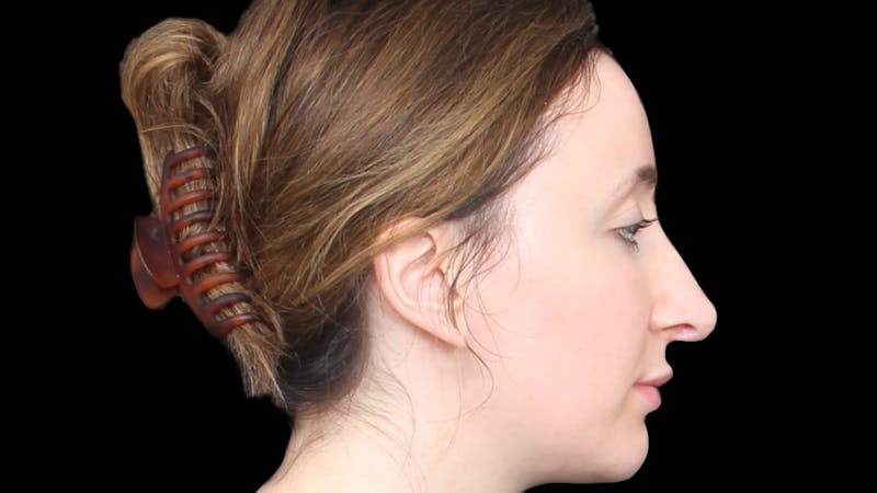Rhinoplasty Before & After Gallery - Patient 289538 - Image 7