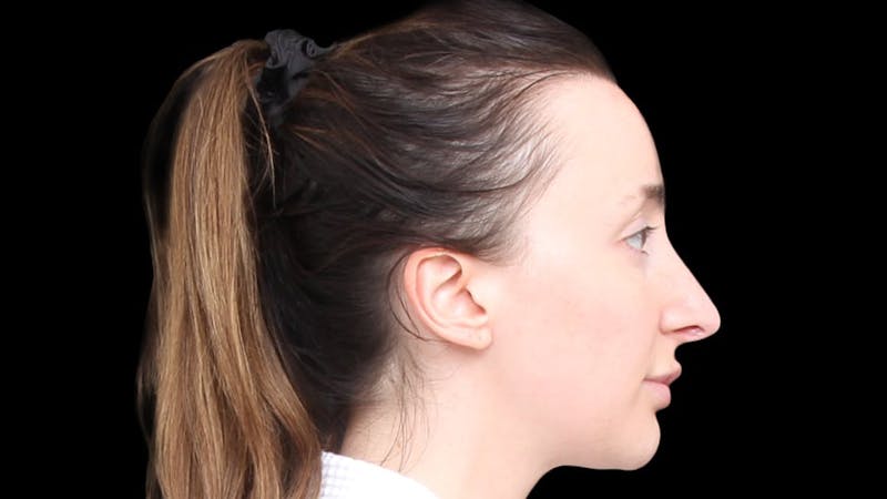 Rhinoplasty Before & After Gallery - Patient 289538 - Image 8
