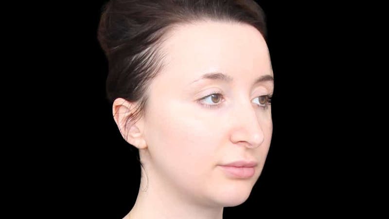Rhinoplasty Before & After Gallery - Patient 289538 - Image 9