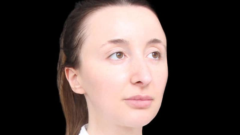 Rhinoplasty Before & After Gallery - Patient 289538 - Image 10