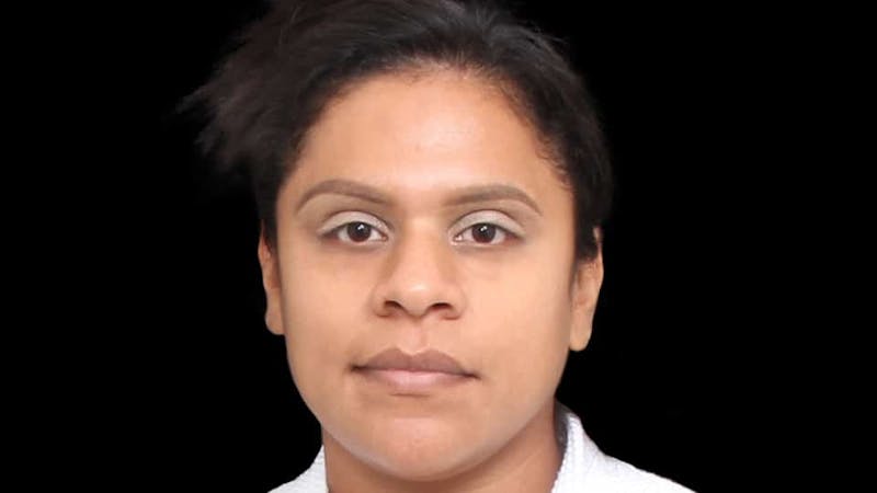 Rhinoplasty Before & After Gallery - Patient 325505 - Image 1