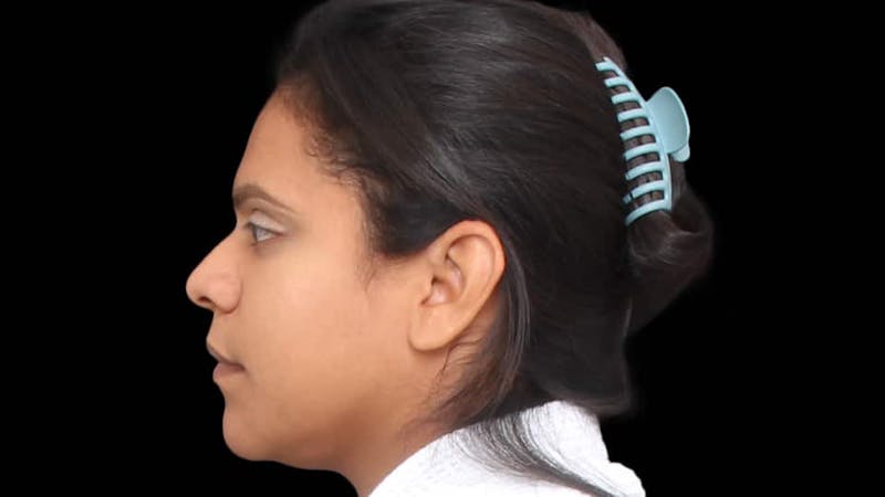 Rhinoplasty Before & After Gallery - Patient 325505 - Image 3