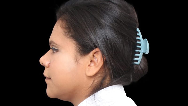 Rhinoplasty Before & After Gallery - Patient 325505 - Image 4