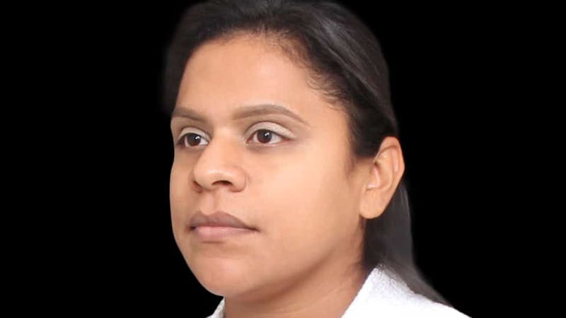 Rhinoplasty Before & After Gallery - Patient 325505 - Image 5
