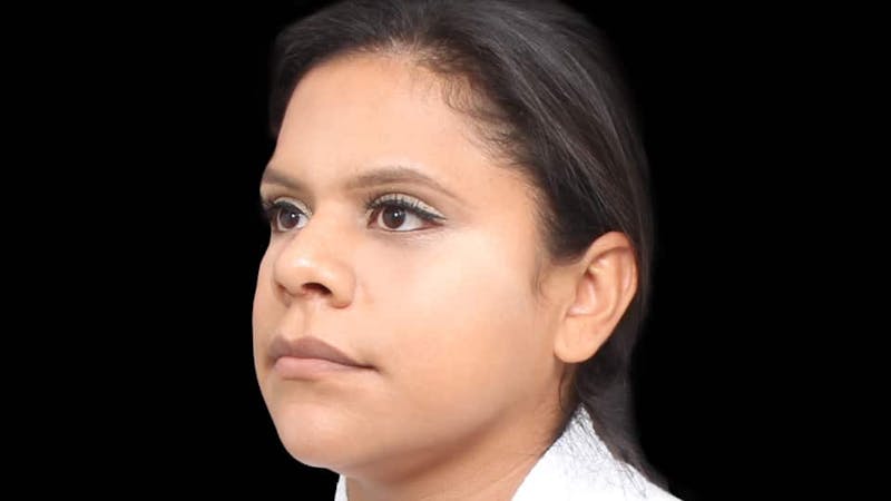 Rhinoplasty Before & After Gallery - Patient 325505 - Image 6