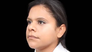 Rhinoplasty Before & After Gallery - Patient 325505 - Image 6
