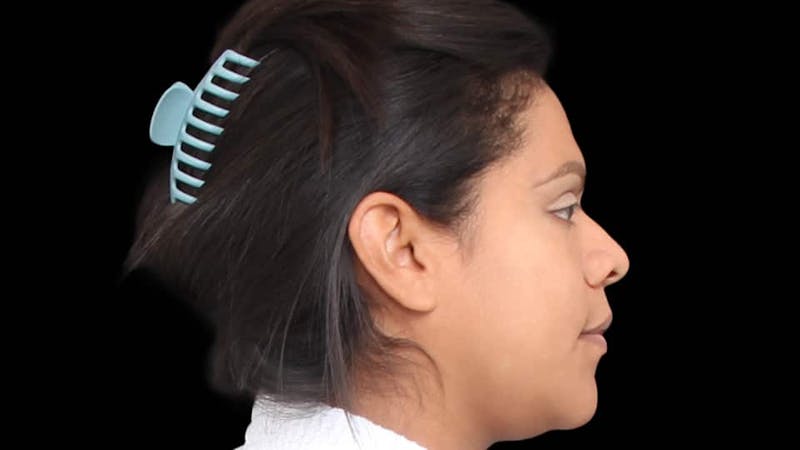 Rhinoplasty Before & After Gallery - Patient 325505 - Image 7