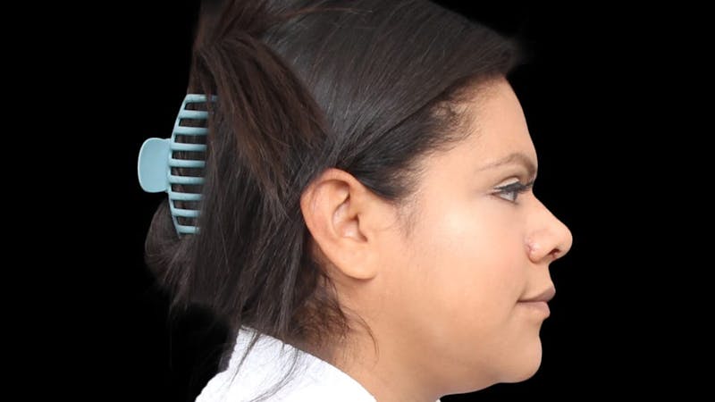 Rhinoplasty Before & After Gallery - Patient 325505 - Image 8