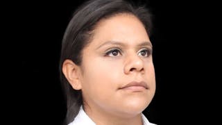 Rhinoplasty Before & After Gallery - Patient 325505 - Image 10