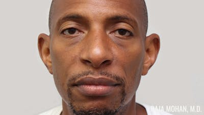 Otoplasty Before & After Gallery - Patient 563200 - Image 1