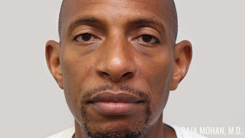 Otoplasty Before & After Gallery - Patient 563200 - Image 1