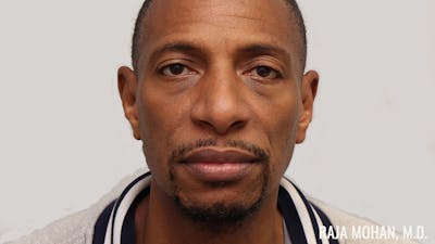 Otoplasty Before & After Gallery - Patient 563200 - Image 2