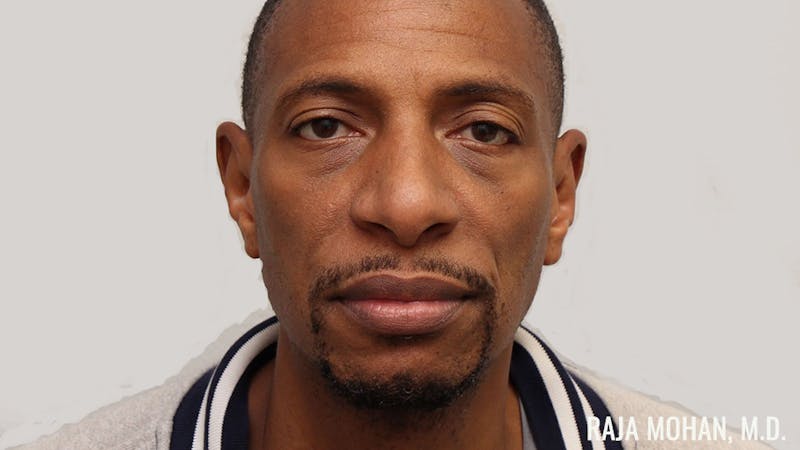 Otoplasty Before & After Gallery - Patient 563200 - Image 2