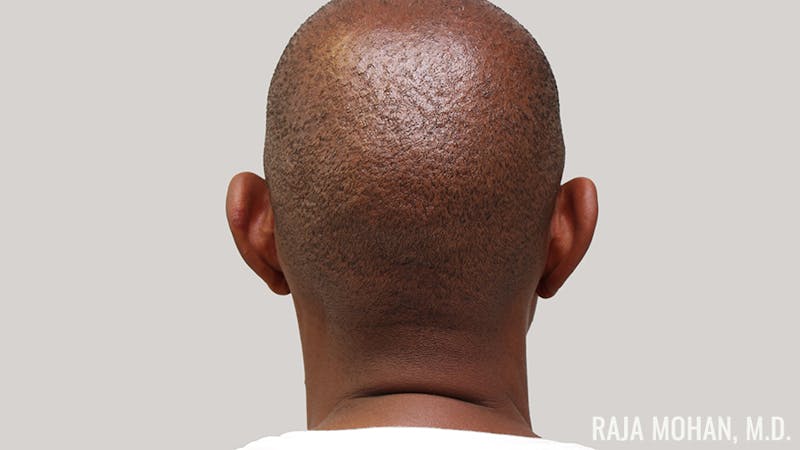 Otoplasty Before & After Gallery - Patient 563200 - Image 3