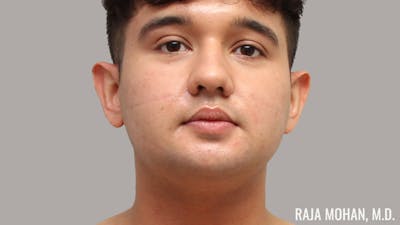 Chin Liposuction Before & After Gallery - Patient 183907 - Image 1