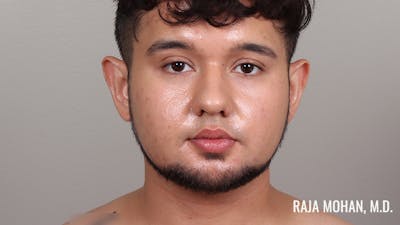 Chin Liposuction Before & After Gallery - Patient 183907 - Image 2