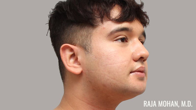 Chin Liposuction Before & After Gallery - Patient 183907 - Image 3