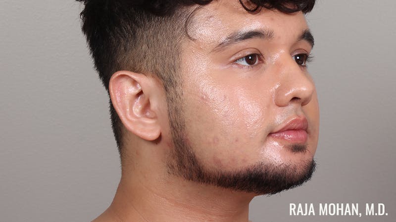 Chin Liposuction Before & After Gallery - Patient 183907 - Image 4