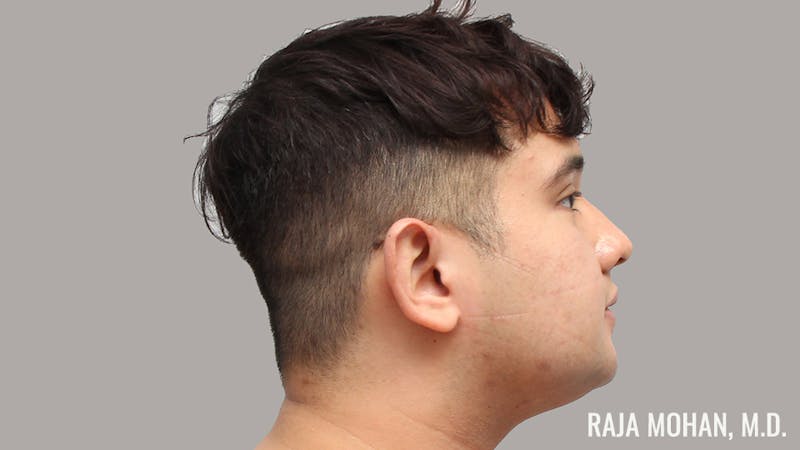 Chin Liposuction Before & After Gallery - Patient 183907 - Image 5