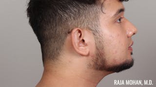 Chin Liposuction Before & After Gallery - Patient 183907 - Image 6