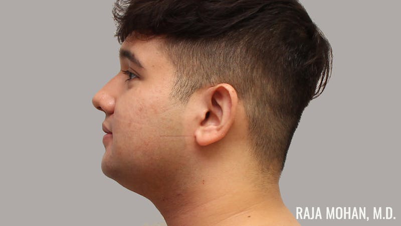 Chin Liposuction Before & After Gallery - Patient 183907 - Image 7