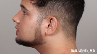 Chin Liposuction Before & After Gallery - Patient 183907 - Image 8