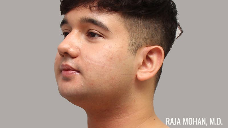 Chin Liposuction Before & After Gallery - Patient 183907 - Image 9