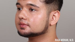 Chin Liposuction Before & After Gallery - Patient 183907 - Image 10