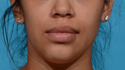 Chin Liposuction Before & After Gallery - Patient 384056 - Image 1