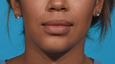 Chin Liposuction Before & After Gallery - Patient 384056 - Image 2